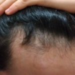育毛実践427日目。（減薬36日目）薬を減らして髪への影響は？